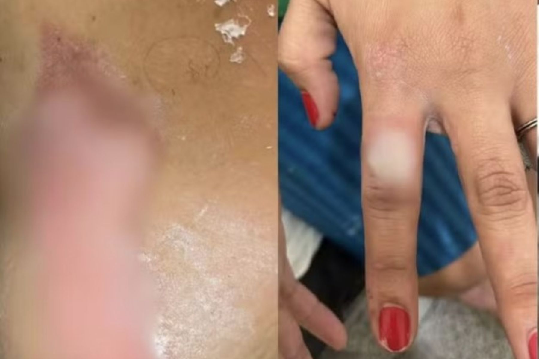 Homem é preso por atear fogo na namorada por ela ter pintado as unhas de vermelho