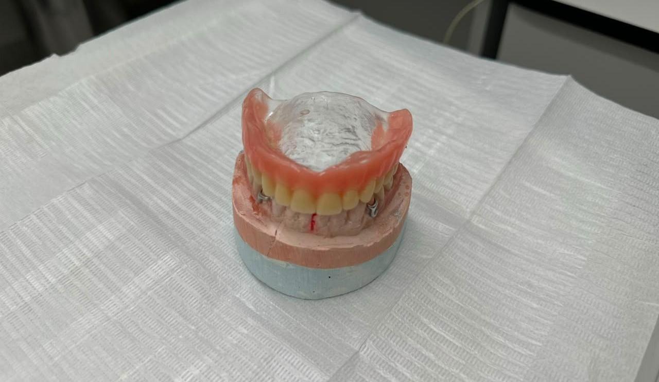 Mutirão de próteses dentárias começa em Timóteo