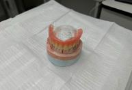 Mutirão de próteses dentárias começa em Timóteo