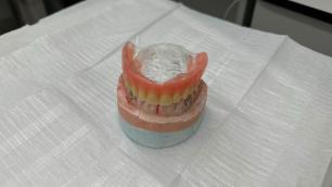 Mutirão de próteses dentárias começa em Timóteo