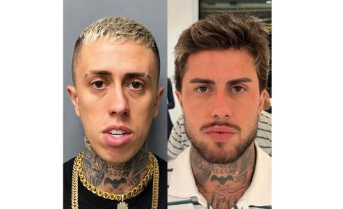 Profissional mostrou como MC Daniel ficou após procedimentos • Divulgação