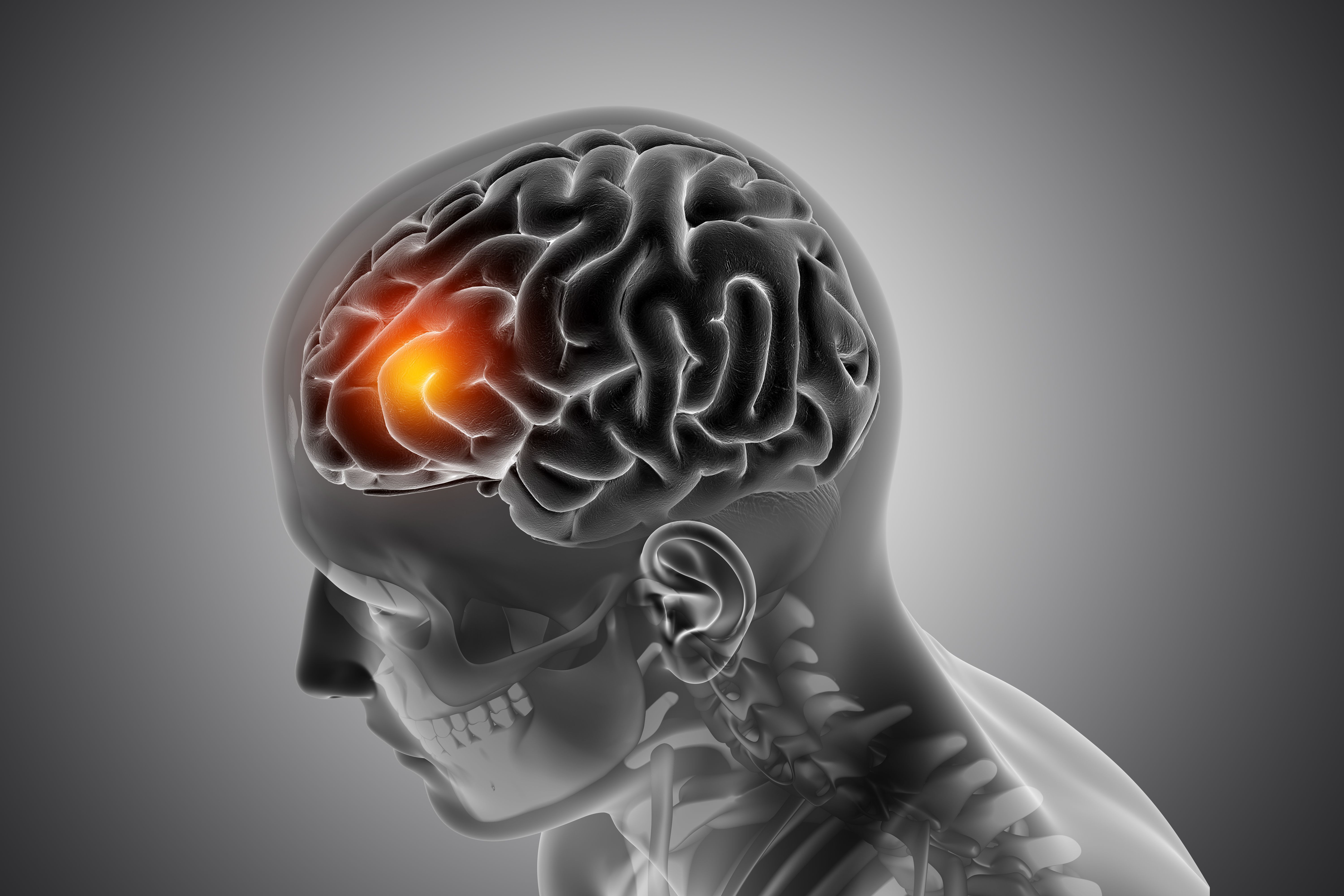 Neurocisticercose: sintomas, diagnóstico e tratamento da infecção cerebral por larvas de tênia