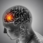 Neurocisticercose: sintomas, diagnóstico e tratamento da infecção cerebral por larvas de tênia