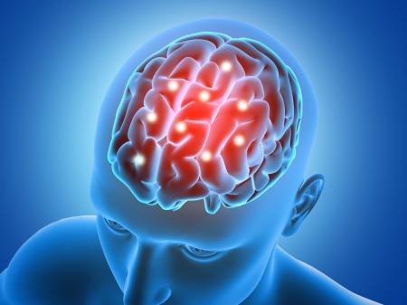 cerebro, avc