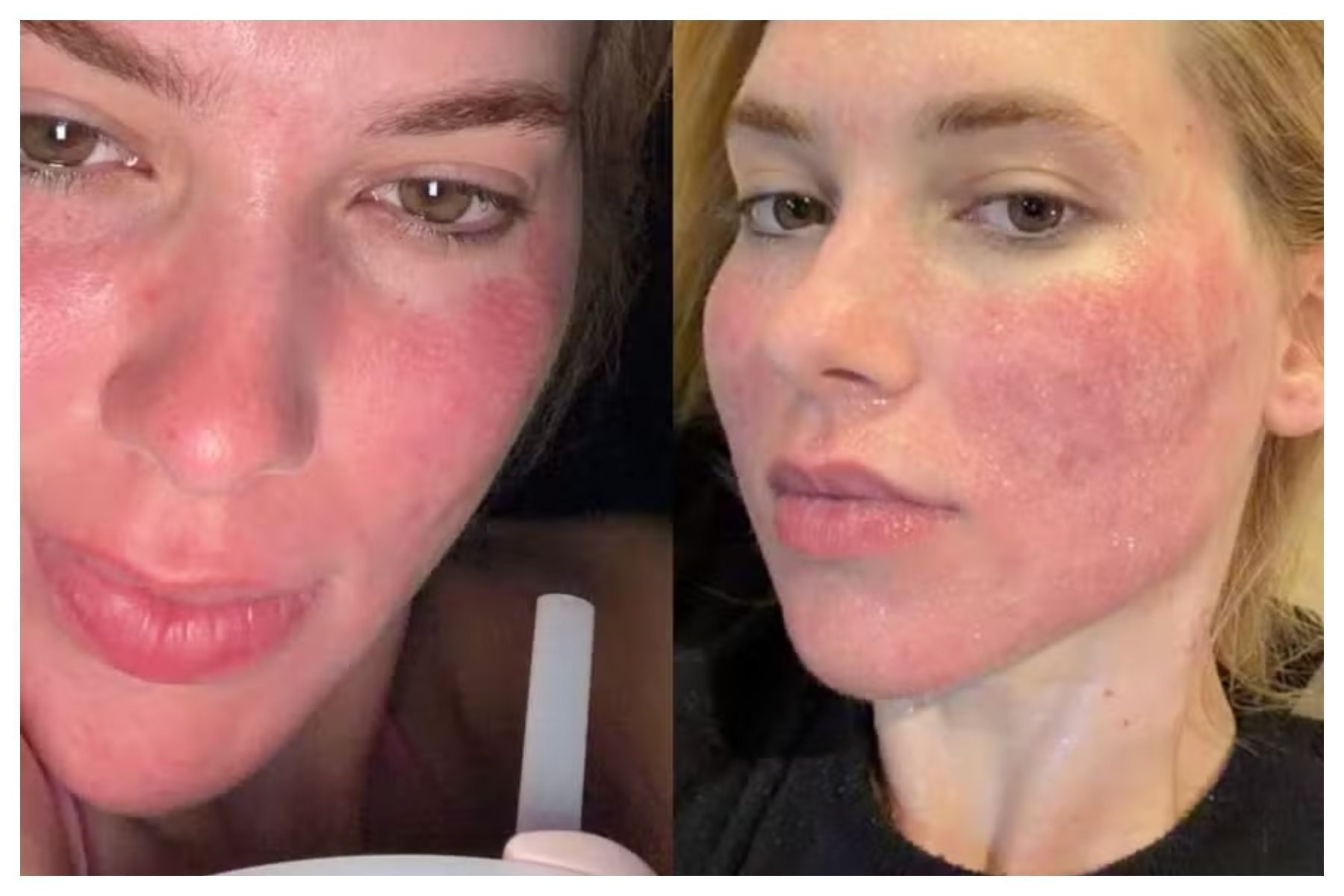 Virginia Fonseca recorre a laser de CO₂ na pele; dermatologista explica procedimento
