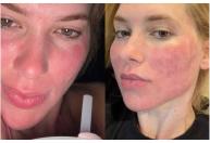 Virginia Fonseca recorre a laser de CO₂ na pele; dermatologista explica procedimento
