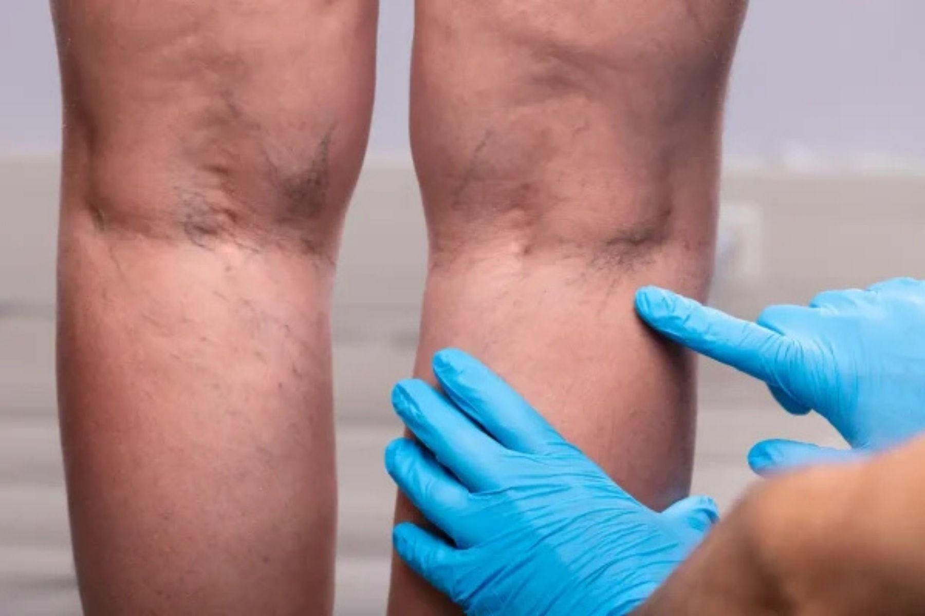 Trombose na perna: como diferenciar de dor muscular e reconhecer sinais graves