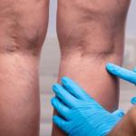 Trombose na perna: como diferenciar de dor muscular e reconhecer sinais graves