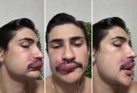 'Triângulo da morte': influenciador é hospitalizado após espremer espinha no rosto