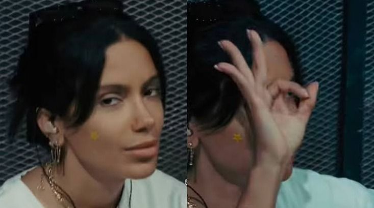 Anitta usa patch para espinha e levanta dúvidas: adesivo de hidrocoloide realmente funciona?
