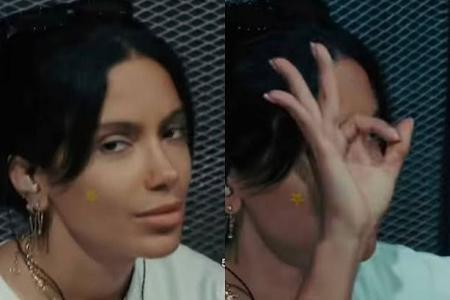 Anitta usa patch para espinha e levanta dúvidas: adesivo de hidrocoloide realmente funciona?