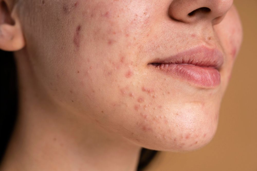 Acne não é tudo igual: veja os cinco tipos e como cuidar da pele em casa