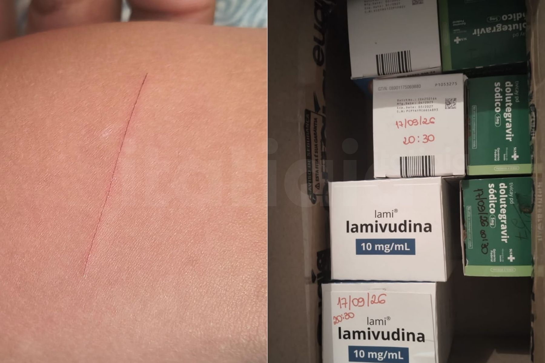Menina de 4 anos inicia tratamento contra HIV após ser ferida por colega em escola de MG