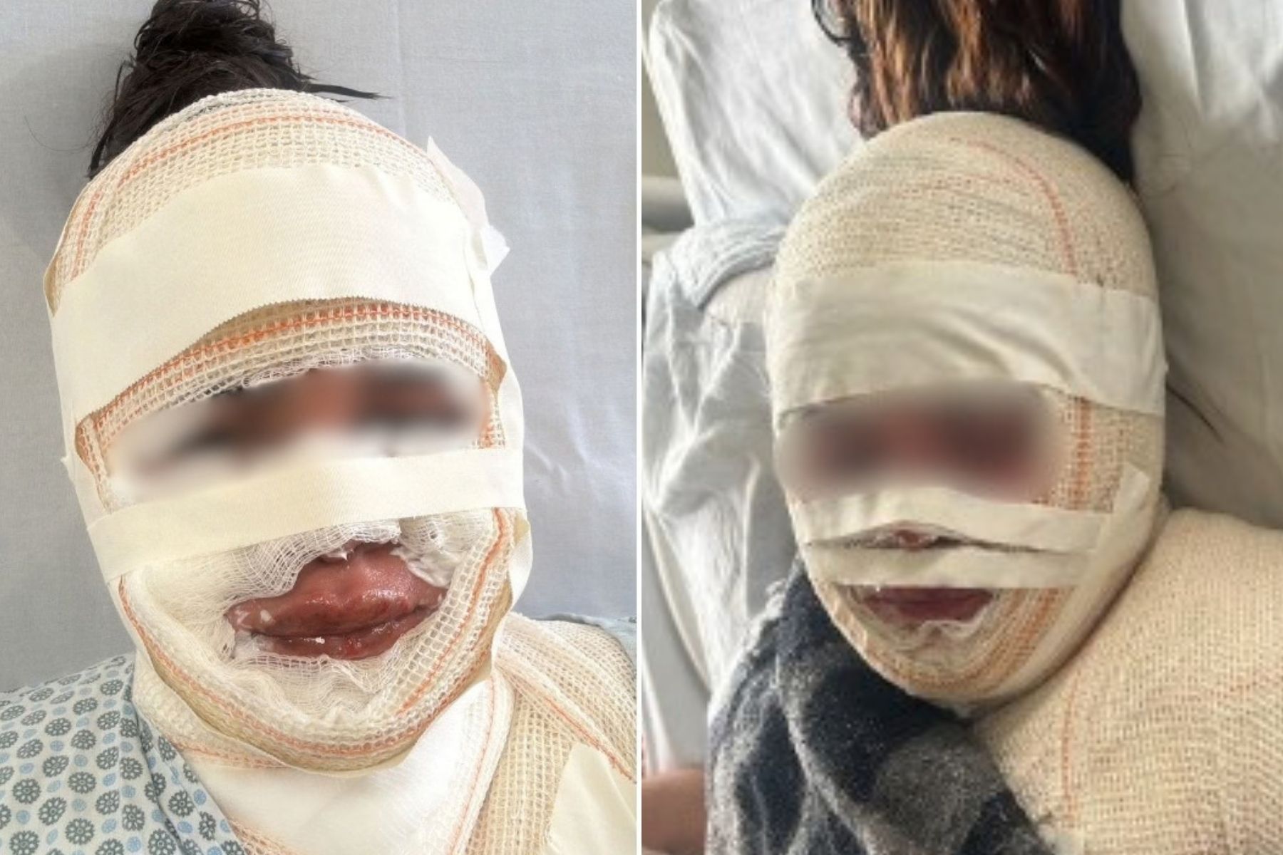 Fisioterapeuta que jogou água fervendo no rosto da atual do ex é presa em BH após novas ameaças
