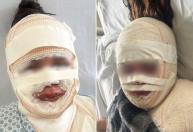 Fisioterapeuta que jogou água fervendo no rosto da atual do ex é presa em BH após novas ameaças