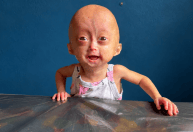 Morre Elis Carneiro, gêmea diagnosticada com síndrome rara de envelhecimento precoce em Roraima
