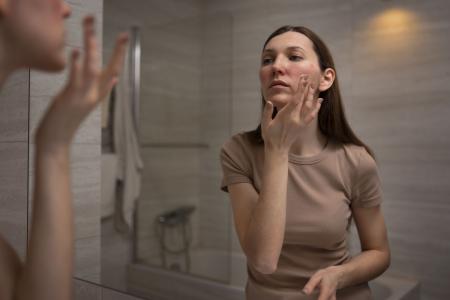 A acne pode continuar depois da adolescência ou surgir pela primeira vez durante a vida adulta.