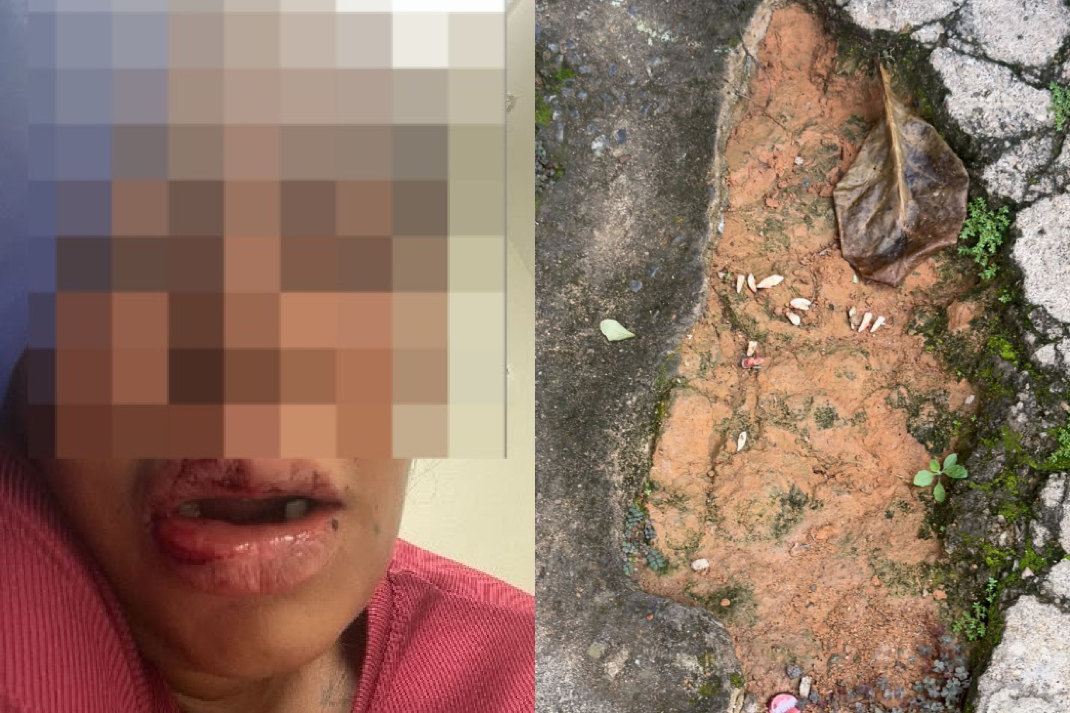 Homem é suspeito de arrancar os dentes da ex-namorada com alicate em MG