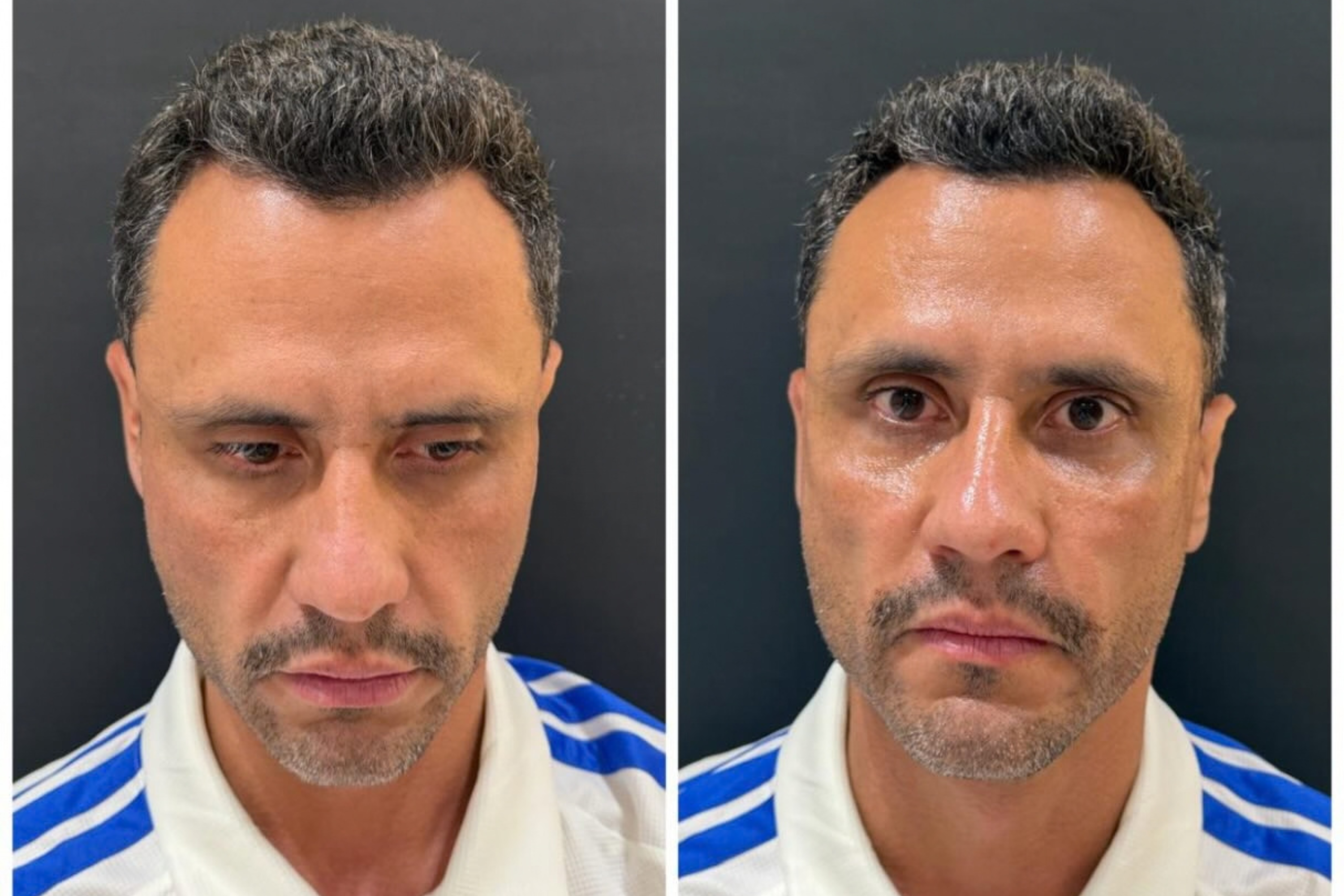 Eleito em 1º turno em Minas, Cleitinho faz harmonização facial após campanha