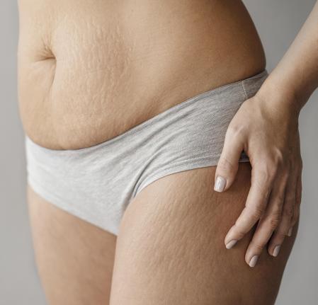 Mulher com marcas de estrias na barriga e na lateral das pernas
